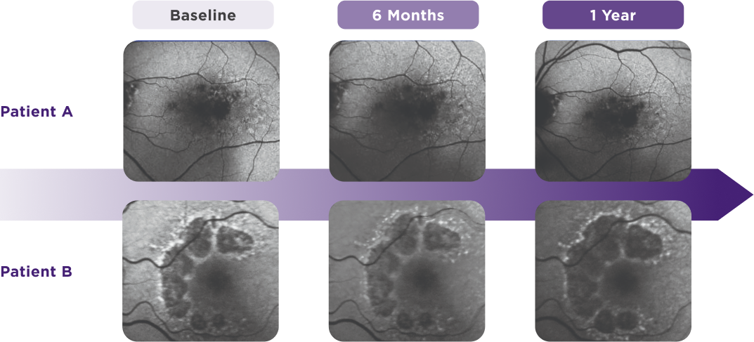 Image of GA progression